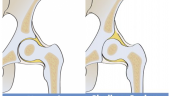 Get CreActive – Raising Awareness of Adult Hip Dysplasia